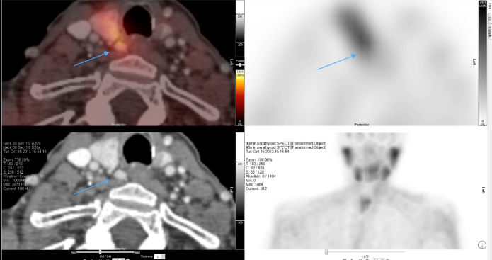 4D CT localising parathyroid in re-operative surgery