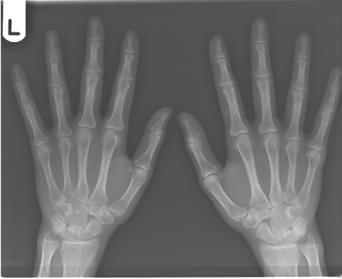 Subperiosteal bone erosion of proximal phalanges and metacarpals in hyperparathyroidism