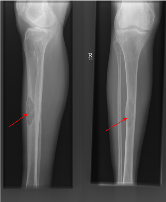 Brown Tumour of Tibia due to hyperparathyroidism